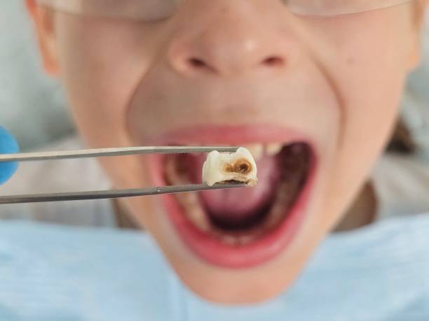 Best Cracked Tooth Emergency Dentist  in Ness City, KS