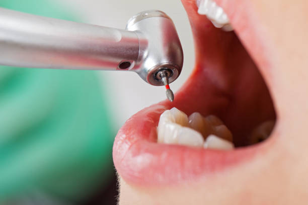 Best Chipped Tooth Repair Near Me  in Ness City, KS